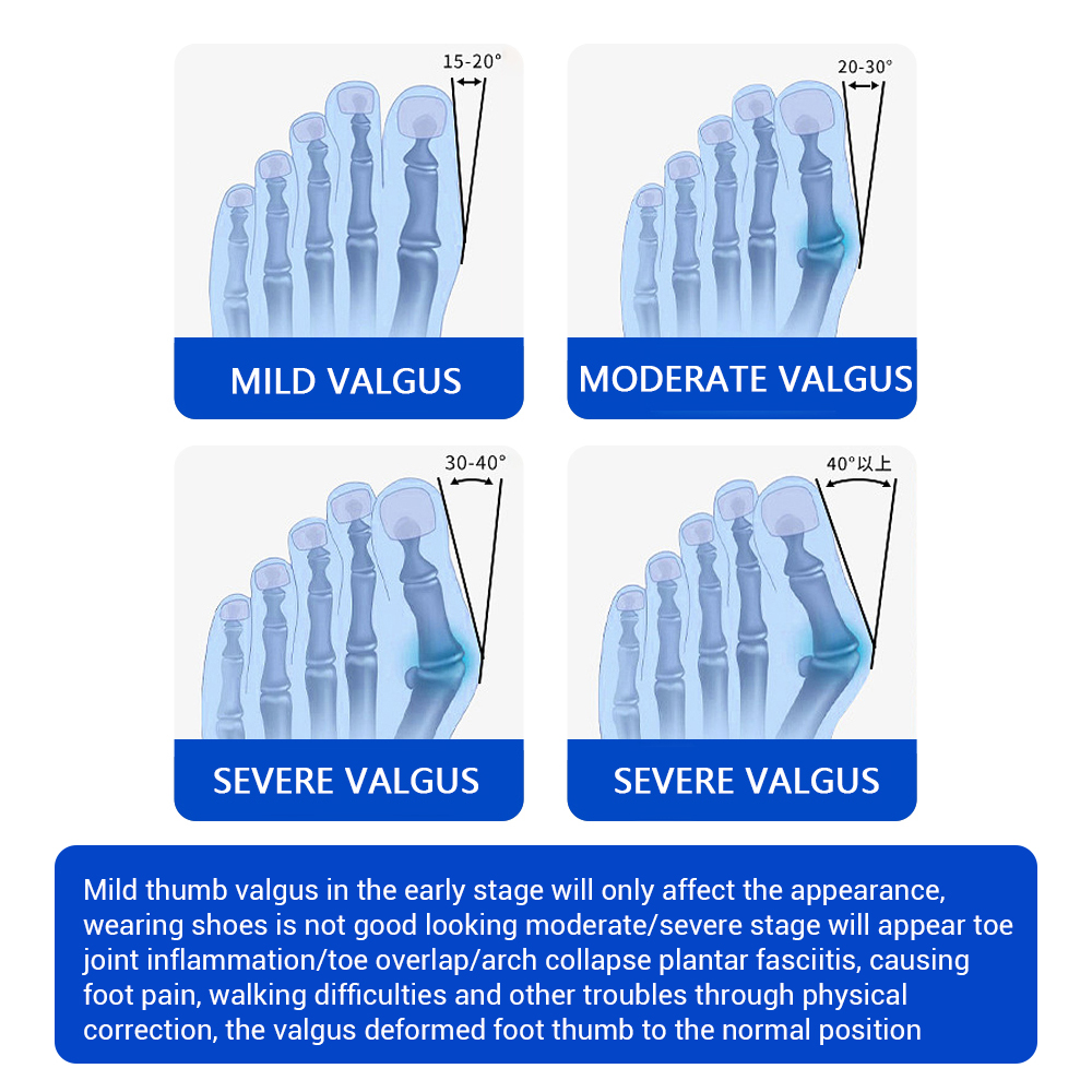 Regolatore per alluce valgo, c - Toe Separator Silicon recensione e prezzo